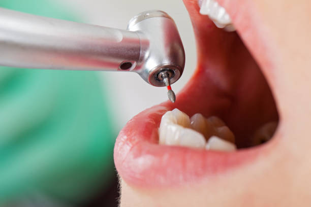 Best Emergency Wisdom Teeth Removal in Easley, SC